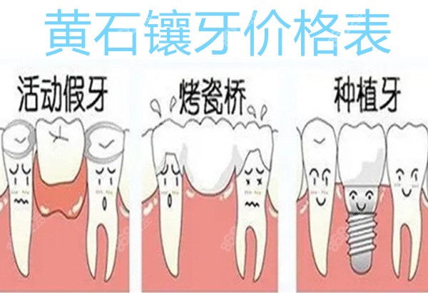 黄石镶牙价格表