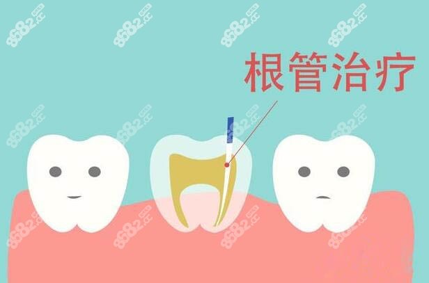 根管治疗卡通图