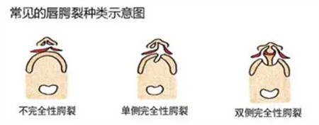 王馳做唇腭裂修復(fù)好不好？