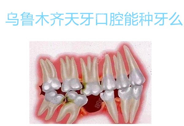 乌鲁木齐天牙口腔能种牙么