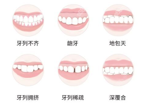 适合做牙齿矫正的症状