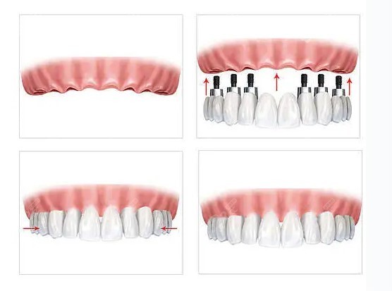 滿口種植牙 滿口種植牙