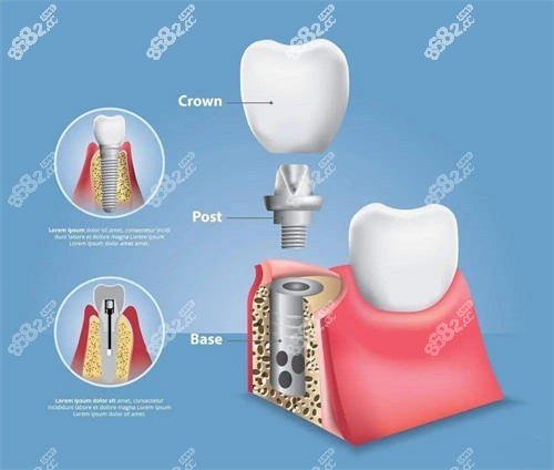 種植牙后悔的原因有哪些？種植牙的8種后遺癥一覽