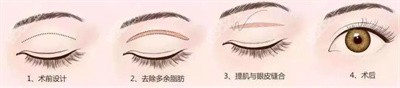 张福元医生在双眼皮整形方面的技术优势3
