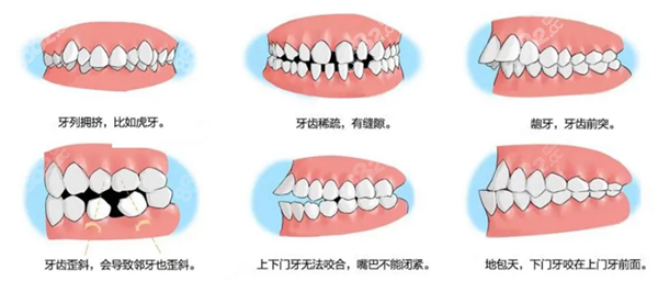 这些情况都需要牙齿矫正