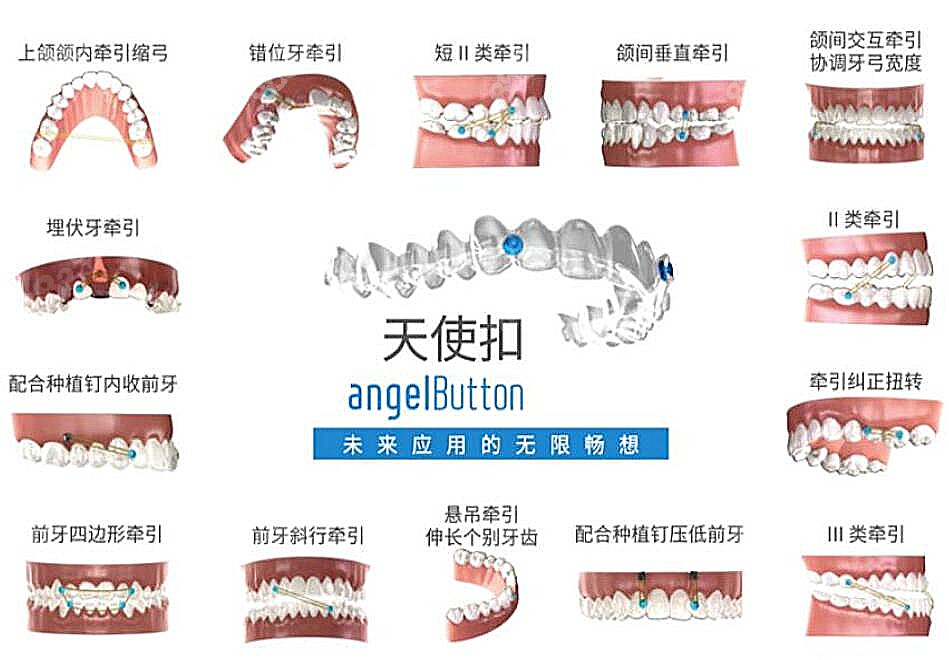 时代天使矫正系统方案