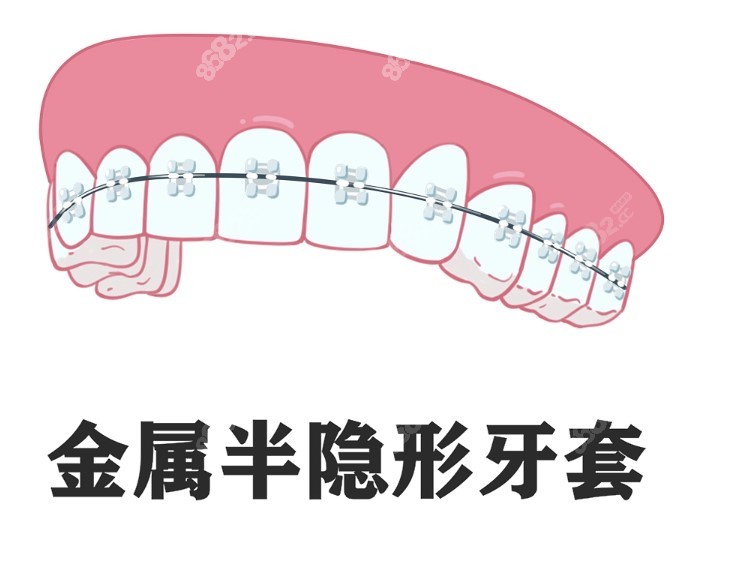 陶瓷半隐形托槽矫正