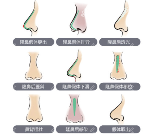 隆鼻失败情况分析