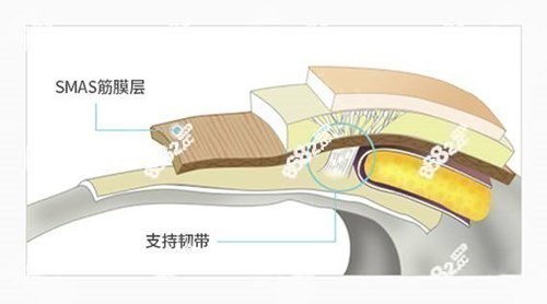 李晓东pdt面部提升原理