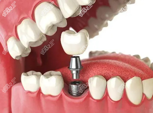 珠海九龍口腔種植牙價格表