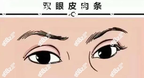 广州美莱田跃平做的双眼皮肉条眼修复前样子