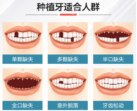 <!--<i data=20240705-sp></i>-->口腔做种植牙的类型