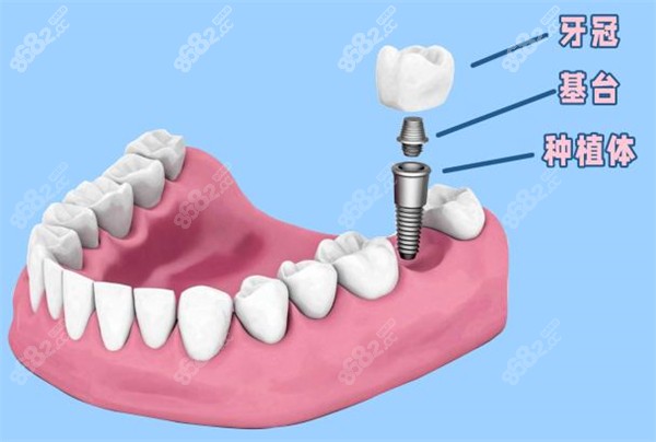 余姚种植牙价格表