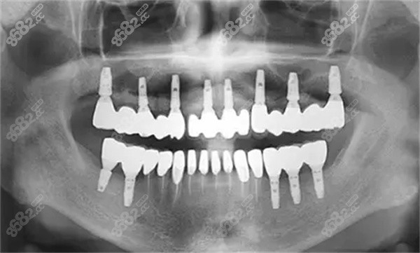 种植牙全景片