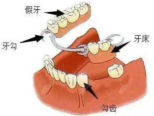 苏州全口假牙价格表