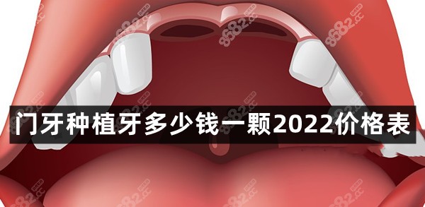 门牙种植牙多少钱一颗2022价格表