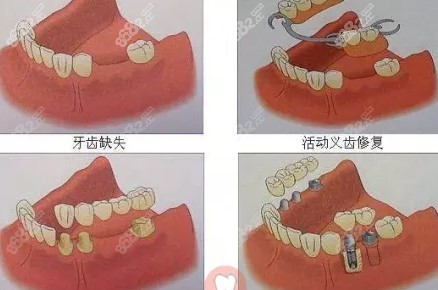 苏州全口假牙价格多少钱