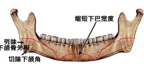 下颌角整形