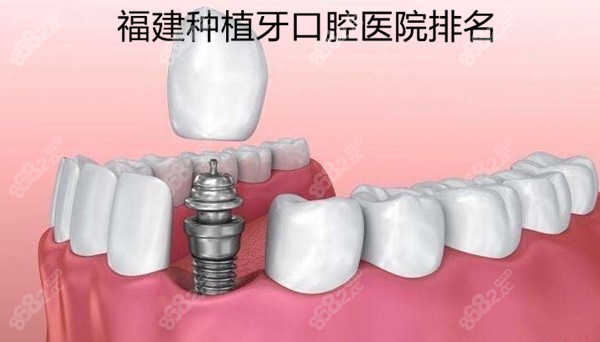 福建种植牙口腔医院排名前十