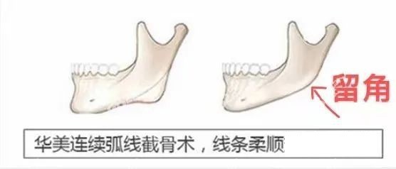 重庆华美潘宝华野生实例反馈磨骨风格自然