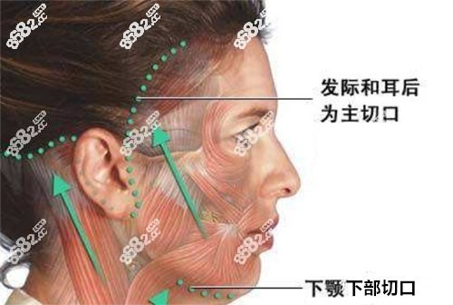 筋膜层悬吊提升手术原理