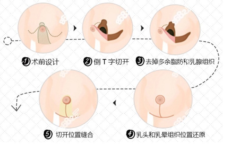 倒T法缩小乳房手术步骤图