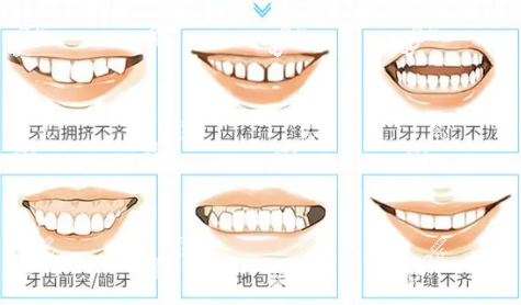 东莞恒好口腔牙齿矫正的类型