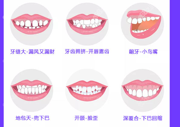 兜齿矫正牙齿的价格8682.cc