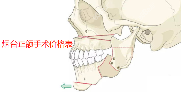 烟台正颌手术费用