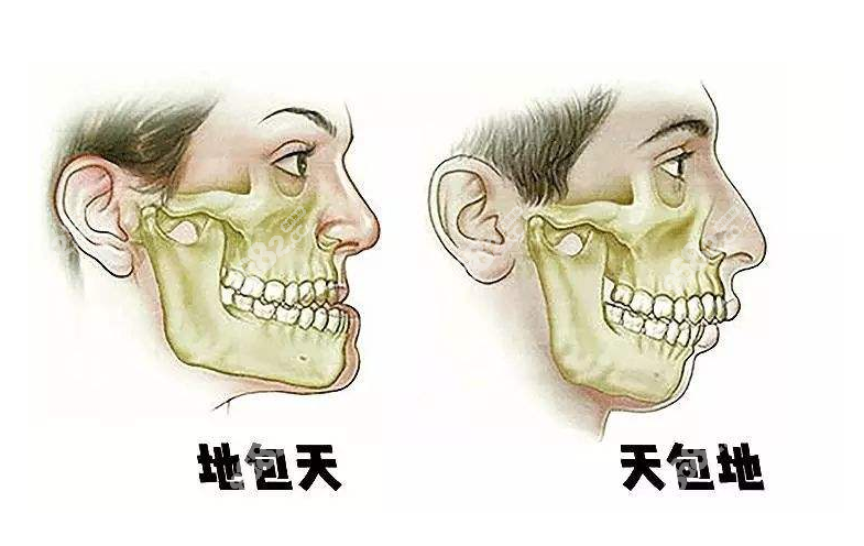 正颌手术情况8682网