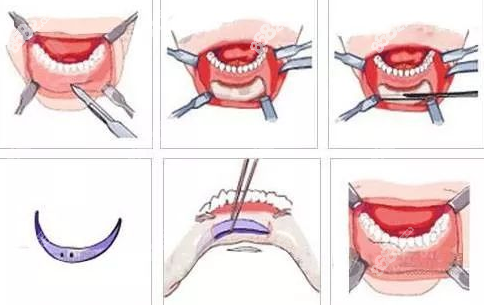正颌手术操作流程
