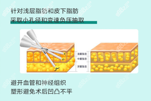 成都华生铂悦威塑吸脂是真的吗