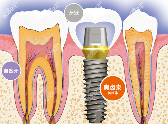 进口奥齿泰种植体