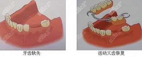 苏州老人满口镶牙价格多少钱