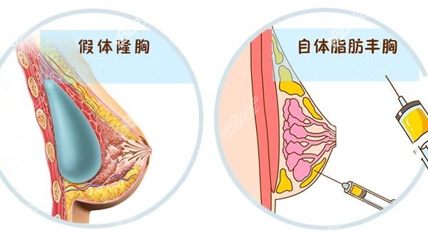 假体隆胸和自体脂肪隆胸示意