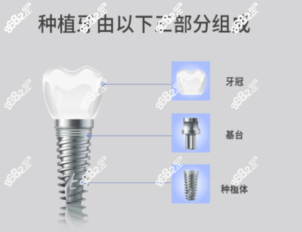 蒙自佳美口腔种牙贵吗