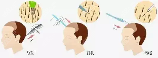 泉州发际线种植价格