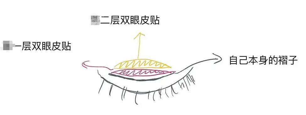 双眼皮