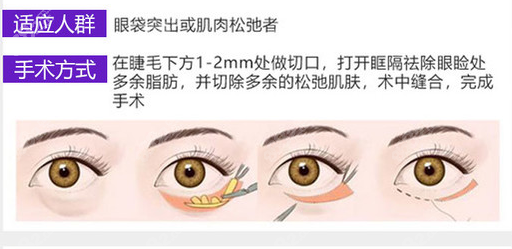 兰州皙妍丽做外切去眼袋的操作方法
