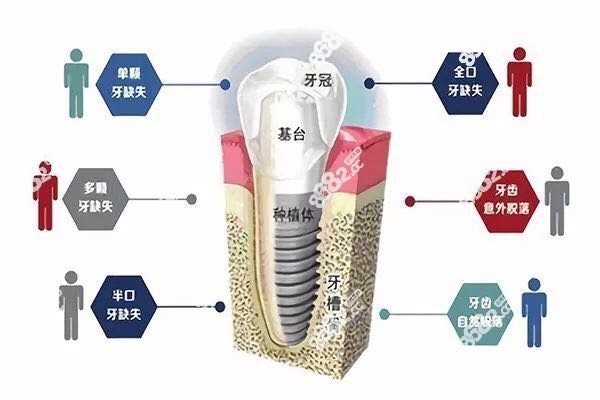 种植牙齿适应症了解下