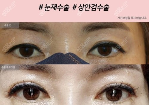 韩国爱护眼修复前后对比照