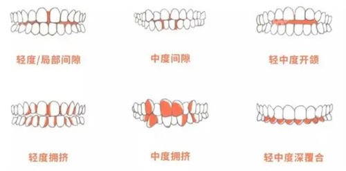 唐山牙博士杨峰涛做正畸怎么样？