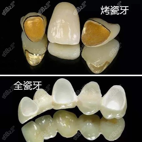 晋城所使用的烤瓷牙和全瓷牙价格不等