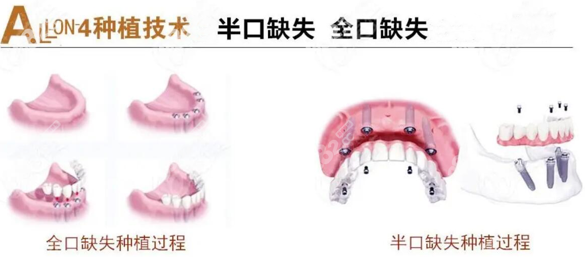 all-on-4全口种植牙过程图示