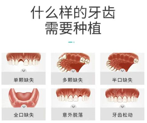 <!--<i data=20240705-sp></i>-->口腔做种植牙的类型