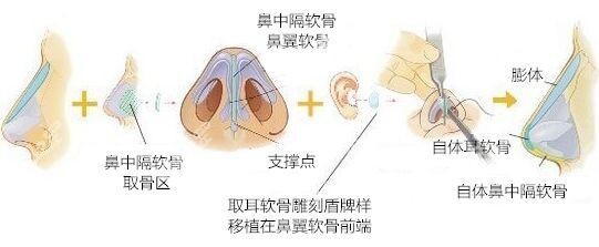 重庆铜雀台梁海彬做鼻子怎么样