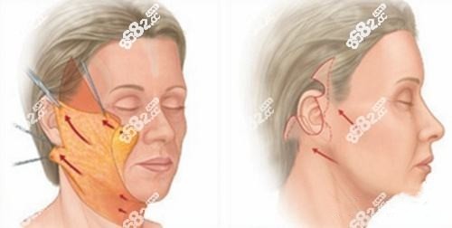 面部大拉皮手术切口图片