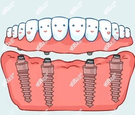 中山香山口腔医院allon4半全口种植牙