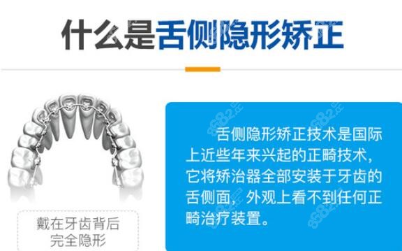 国内舌侧隐形矫正牙齿价格是多少钱