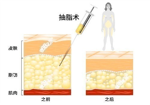 美贝尔快乐吸脂